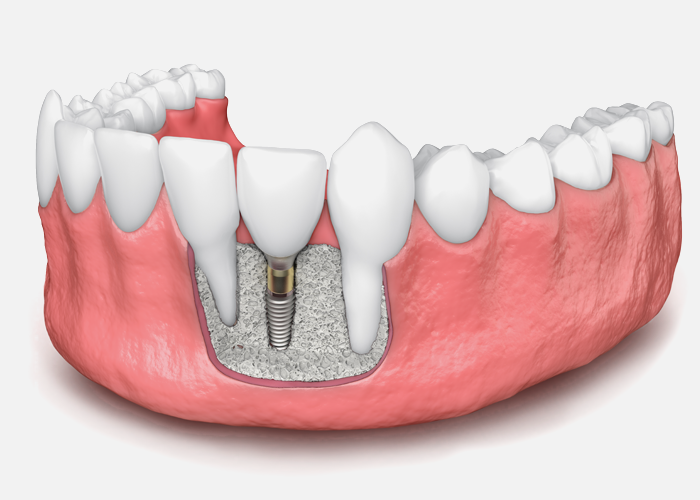 Whitening Bone grafting