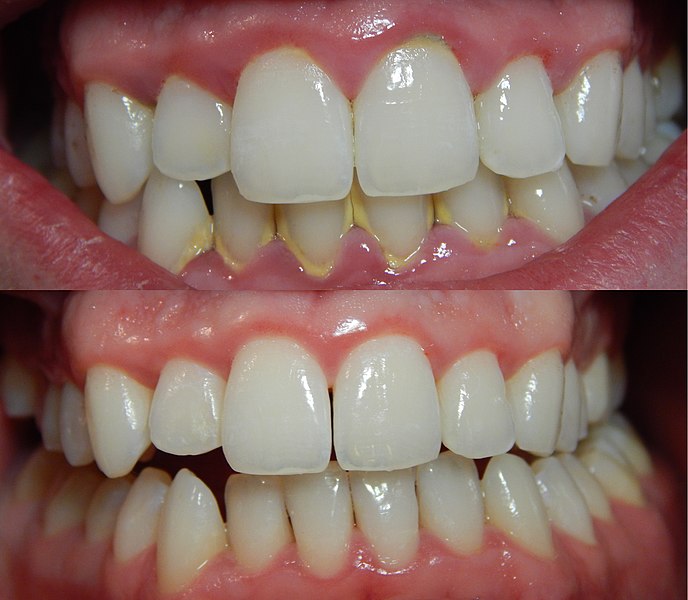 Tartar removal and polishing