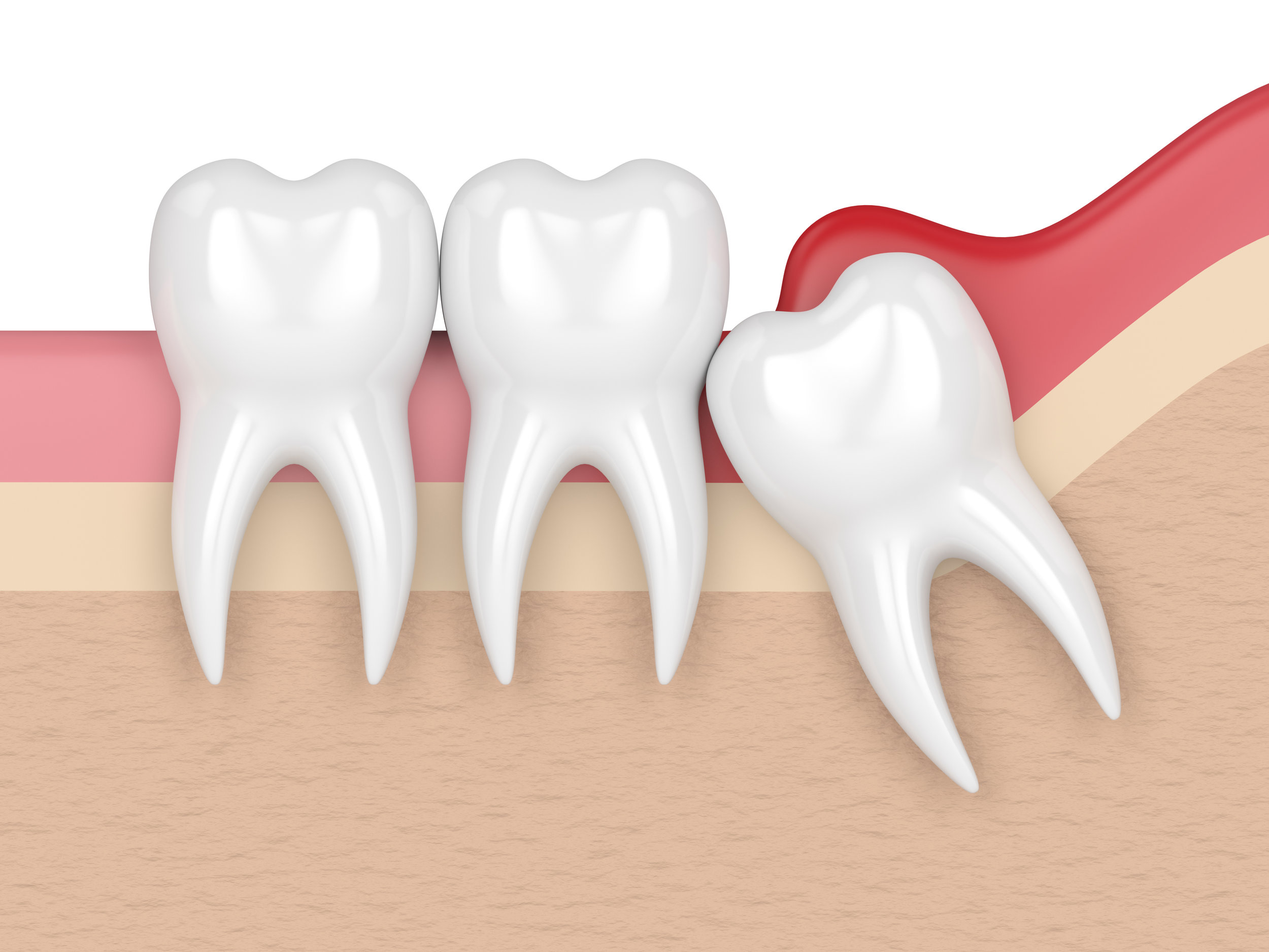 Wisdom tooth treatment