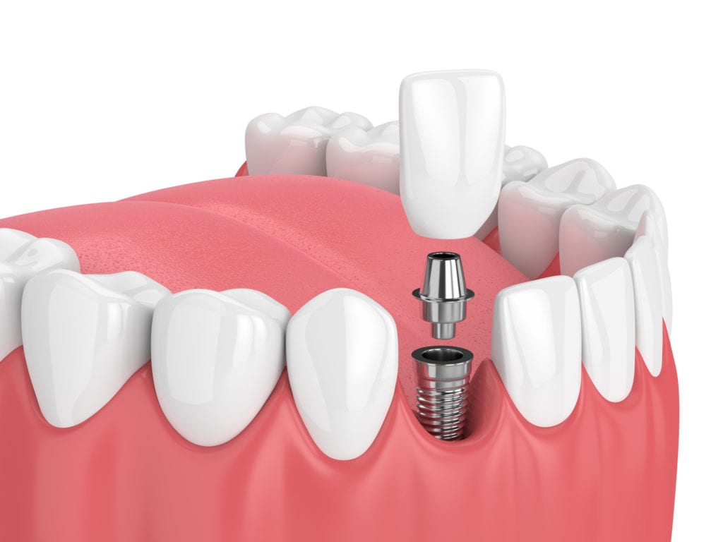 Implant Treatment